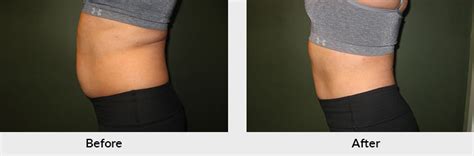 coolsculpting in charlotte nc.